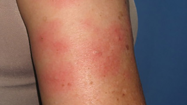 10 Skin Rashes Caused By Ulcerative Colitis