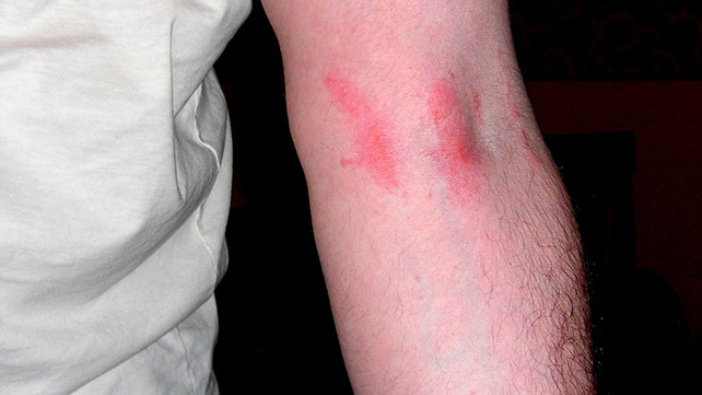 Poison Sumac: Rash, Pictures, and Treatment